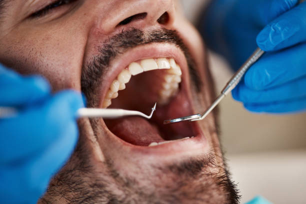 Best Emergency Tooth Extraction in Honeygo, MD